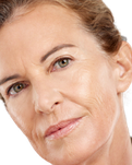 We treat lines and wrinkles
