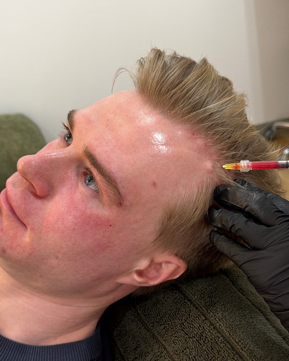 Dr Brandon having PRP injected along his hairline at Cleon in Potts Point
