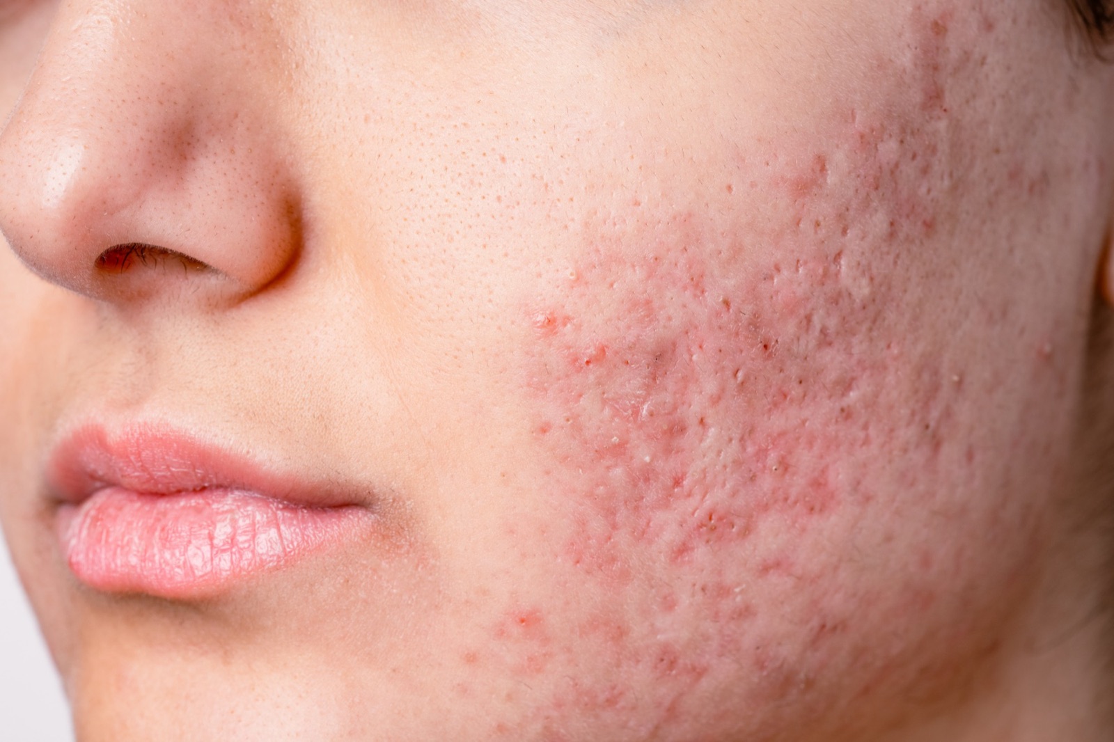 Close-up of a cheek with pitted acne scarring