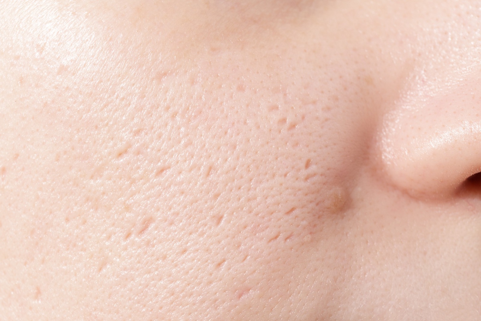Close-up of cheek skin beside the nose showing enlarged pores and uneven texture