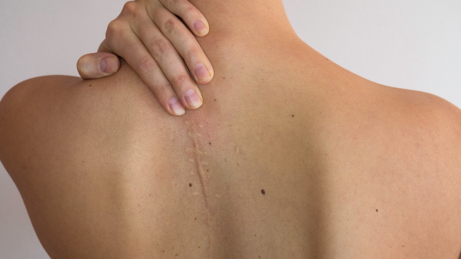 A healed surgical scar running down the centre of an upper back