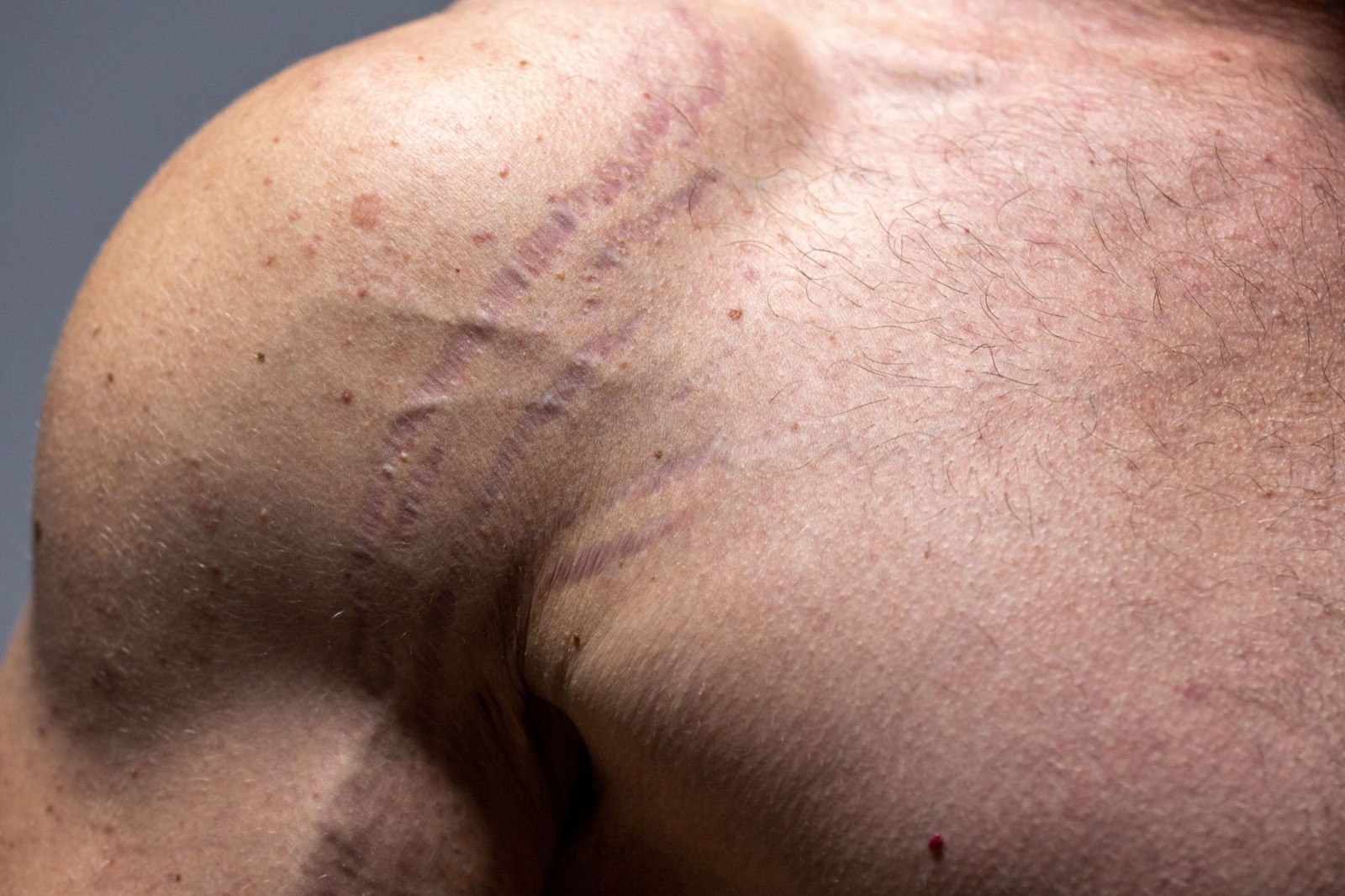 Stretch marks across a shoulder