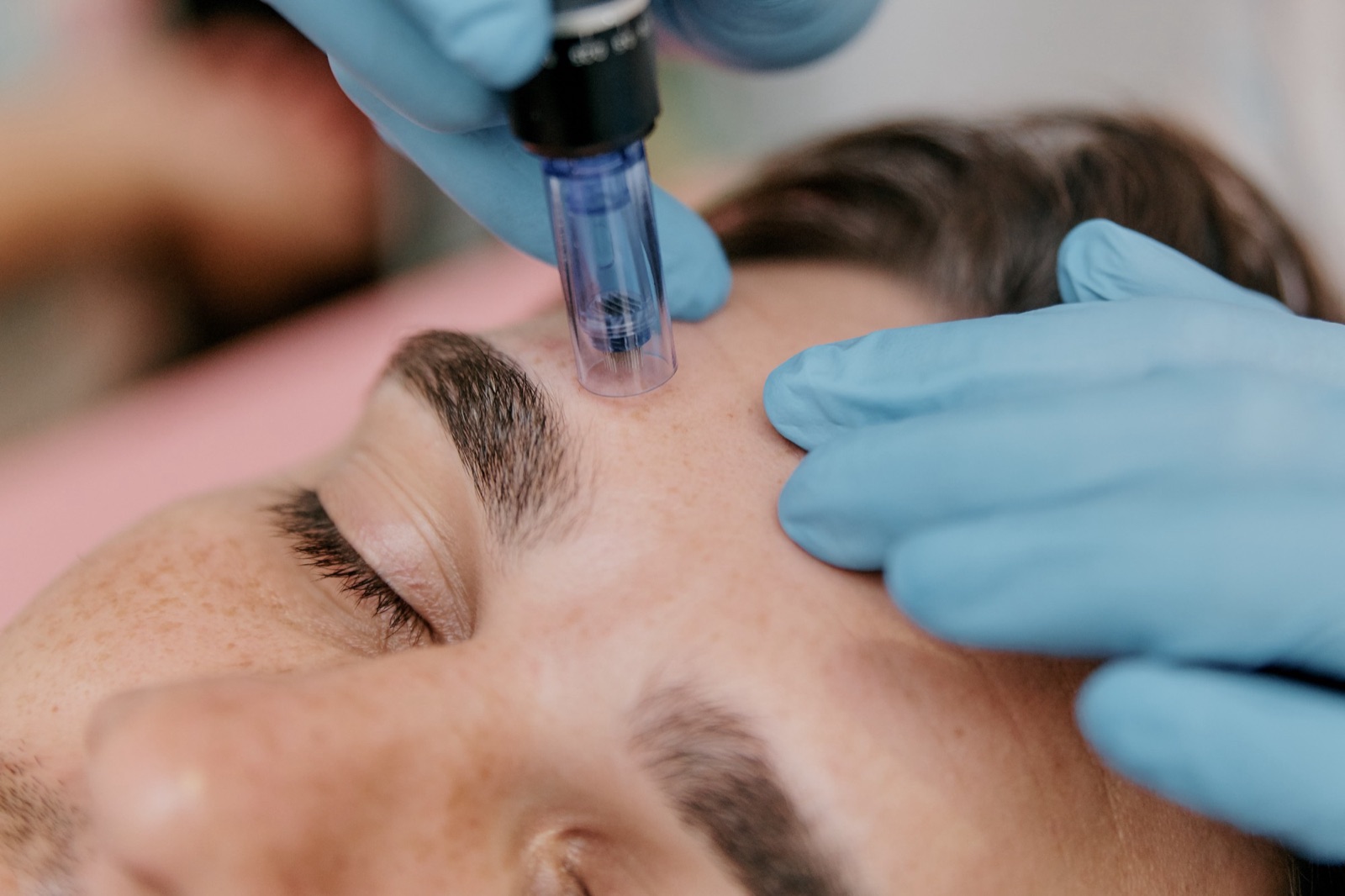 Skin needling pen being guided across a patient's forehead by a gloved hand