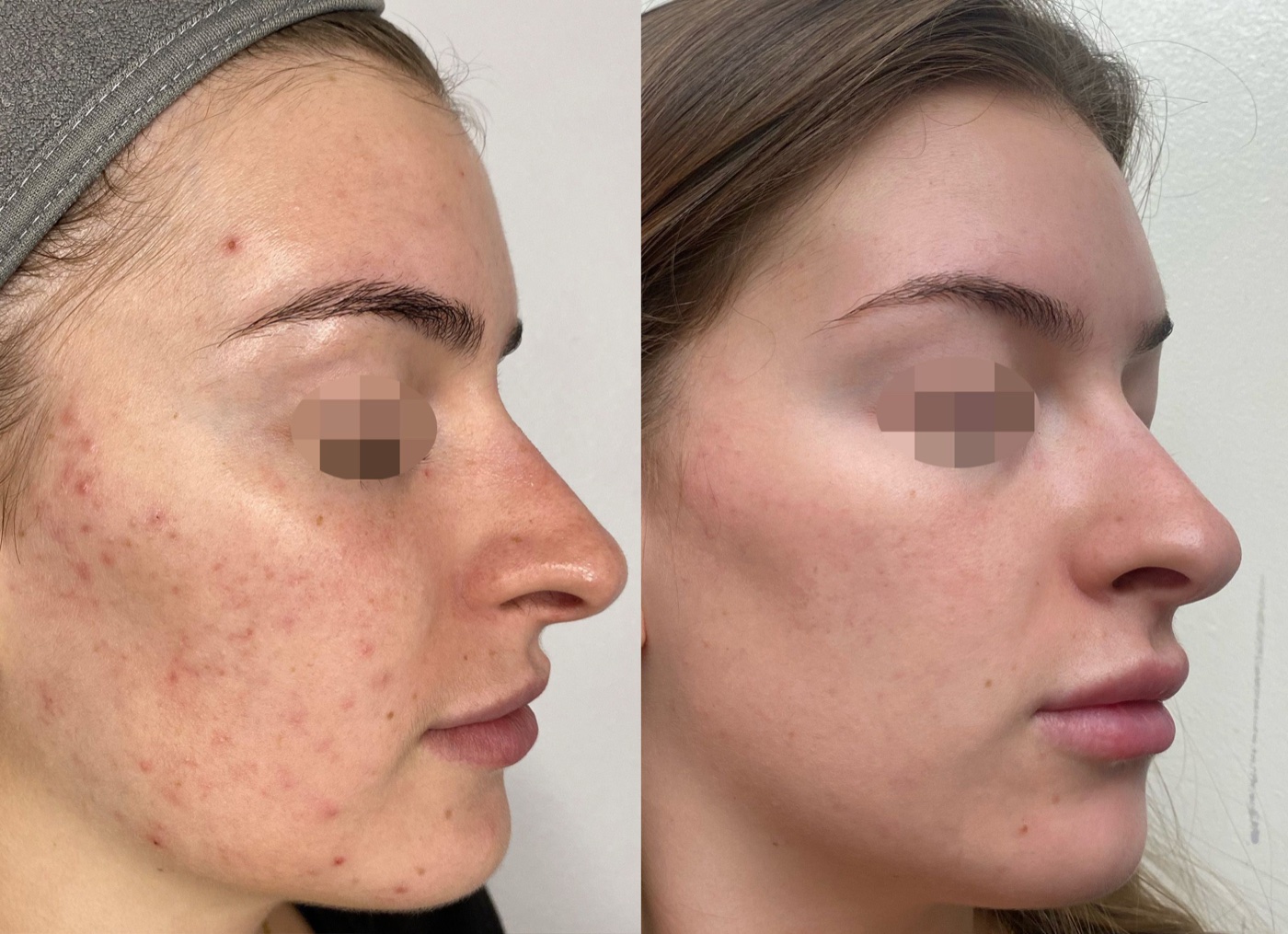 Side view of a woman's cheek with red breakout marks and uneven texture before treatment, and clearer, more even skin after five SoftLift sessions. Eyes pixelated.
