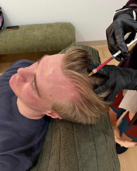Receding hairline