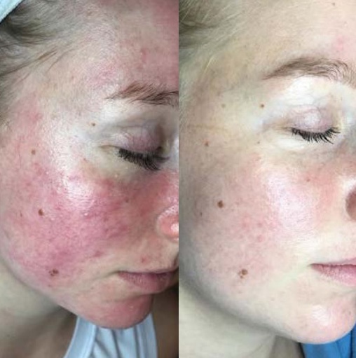 Cheek with active breakouts and redness before treatment, and visibly calmer skin after