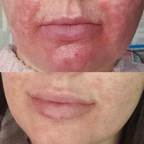Inflamed skin around the mouth before treatment, and settled skin after