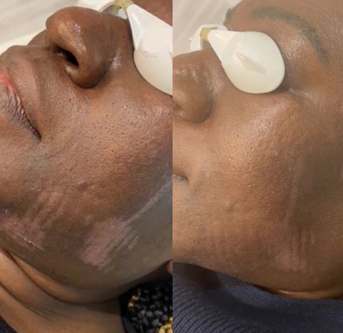 Cheek and jaw on deeper skin with patchy, uneven areas before treatment, and a more even tone after
