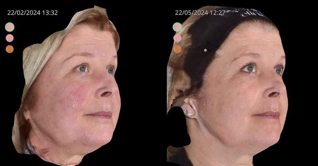 Three-quarter view of a face before and after a course of treatment