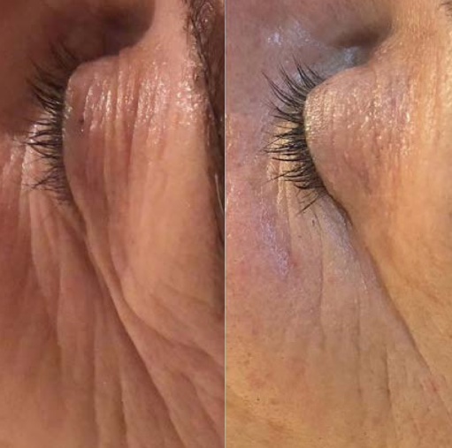 Close-up of fine lines at the outer eye before and after treatment